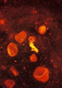 A test for TB, a sputum smear stained using fluorescent acid fast stain © CDC/R W Smithwick
