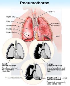 Pneumothorax was a type of surgery used as TB treatment before drugs became available
