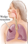 Wedge resection surgery for the treatment of TB