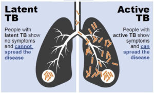 Types of TB